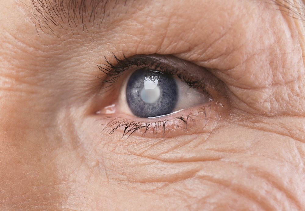 Senior woman with visible cataracts - learn how to prevent cataracts from our Nashville Eye Doctor