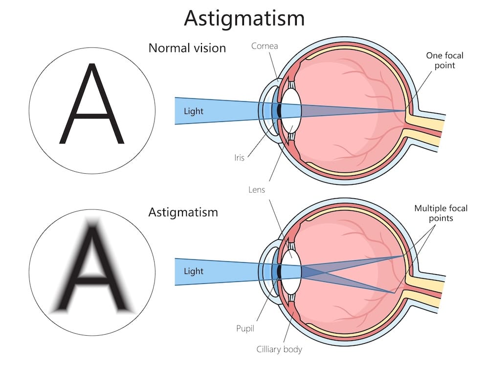 Graphic depicting the changes from an astigmatism