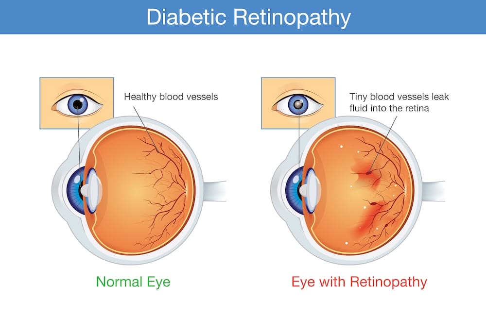 A normal vs. diseased retina demonstrating the effects of diabetes and eyesight